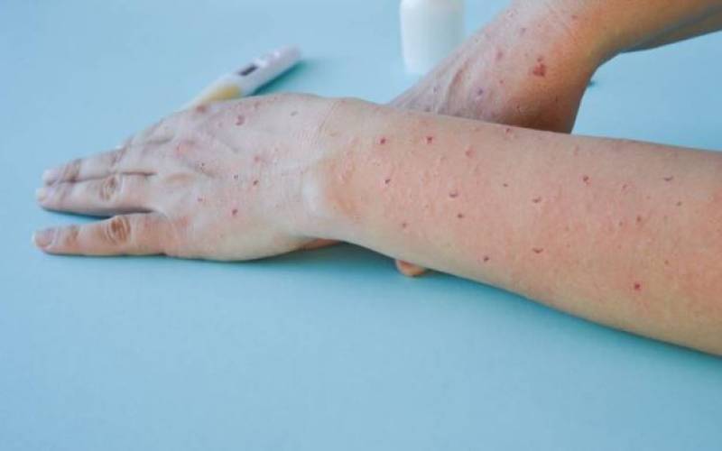 Second Mpox infection detected in Region of Murcia